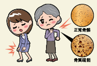 20191008骨質酥鬆 200x136 1